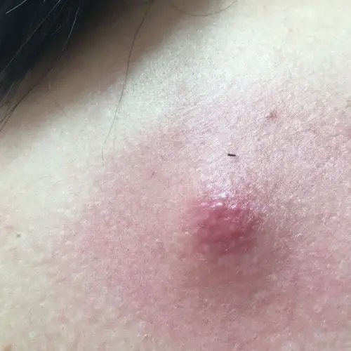 背上长了很大的痘痘… 该怎么弄掉!求帮助啊!