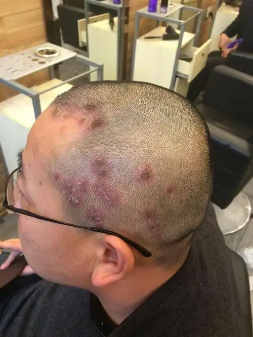 头皮发红,上结壳,掉头皮很多,医生说是银屑病,好多人说不像,附照片,请