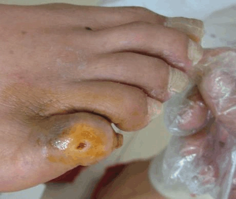 糖尿病足分级照片