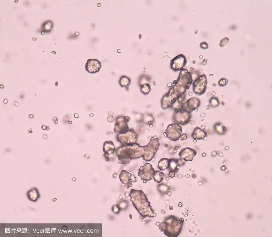 尿中的尿酸结晶