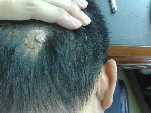 自小就有块不长发的,现在20几了,看起来很不雅观,样子又很瘊子一样