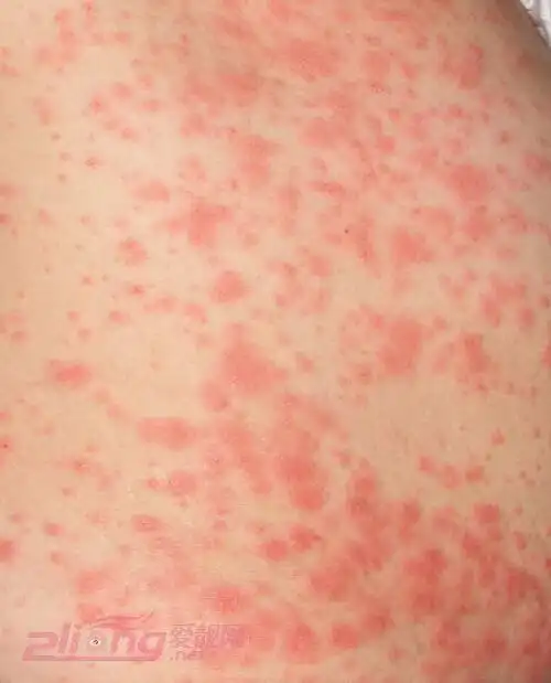 嫩绿!小儿皮肤过敏症状"一蹴而就"-第1张图片-品冠网