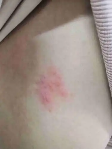 背上起了一片红疙瘩会痒是什么原因?_百度知道