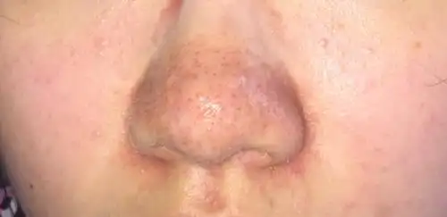 17女 鼻子毛孔特别粗大 如图 爱出油 该怎么办