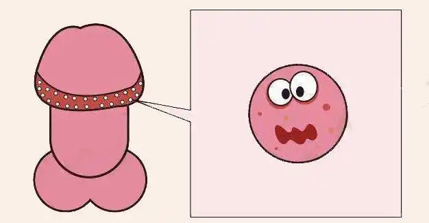惊奇地发现龟头边缘有一圈小疙瘩,半透明,大概米粒大小,也不疼也不痒