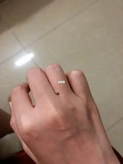 从小到现在右手的手指缝隙有颗痣有同款的吗
