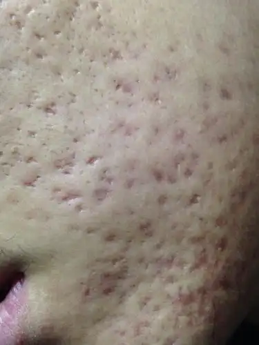 从长痘痘再到祛除痘痘有将近半年的时间然后留下了这些痘坑痘印.