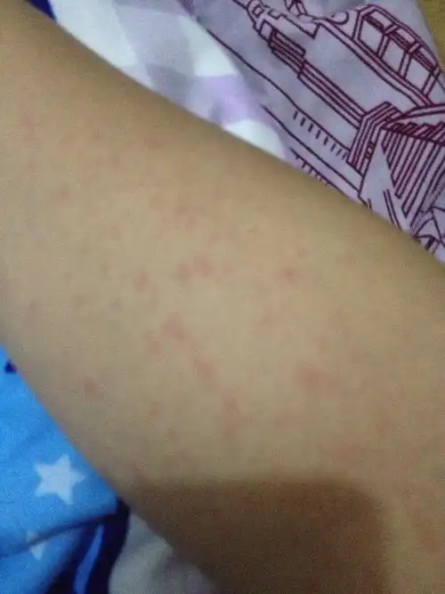 吃芒果,但以前也经常吃都没事的,或者是昨天在厨房用威猛打扫卫生过敏