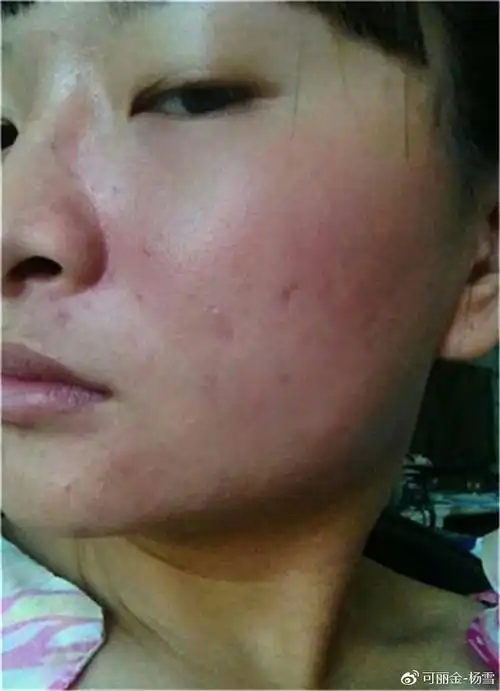 红血丝敏感肌必点