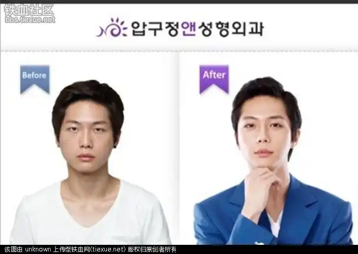 海量:韩国人整容前后的照片对比