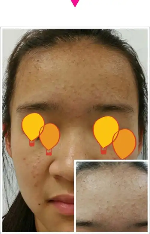 从婴儿到成人—痤疮简介