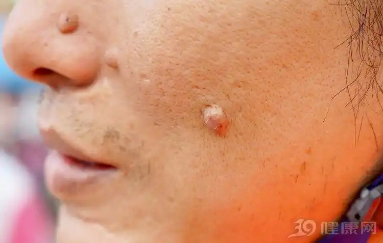 医生给出3个解释|传染性软疣|疙瘩|丝状疣_新浪新闻