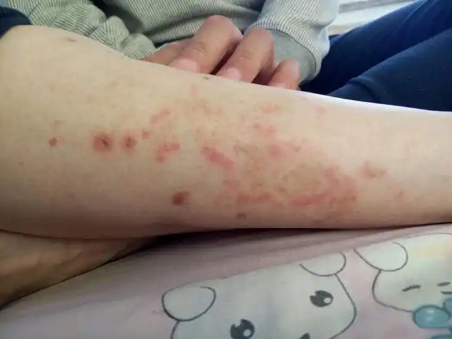 现在出院在家养着最近他出现了这样的红疹子我们都不知道这是什么怎