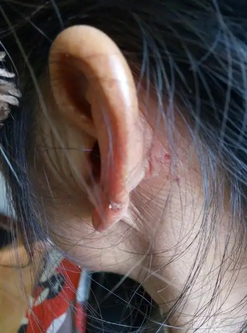 发布了新帖 皮肤病吗4天前     帮忙看下这是不是皮肤癣,老妈耳朵