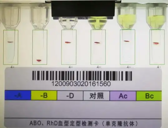 11 月 27 日因 「阑尾炎」 在我院住院治疗,检验科在对其 abo,rh 血型