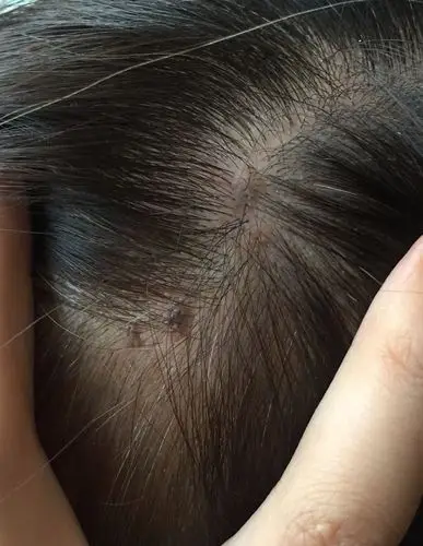妈妈最近突然发现头皮上长了一些像瘊子又像疣的突起,请问是什么?
