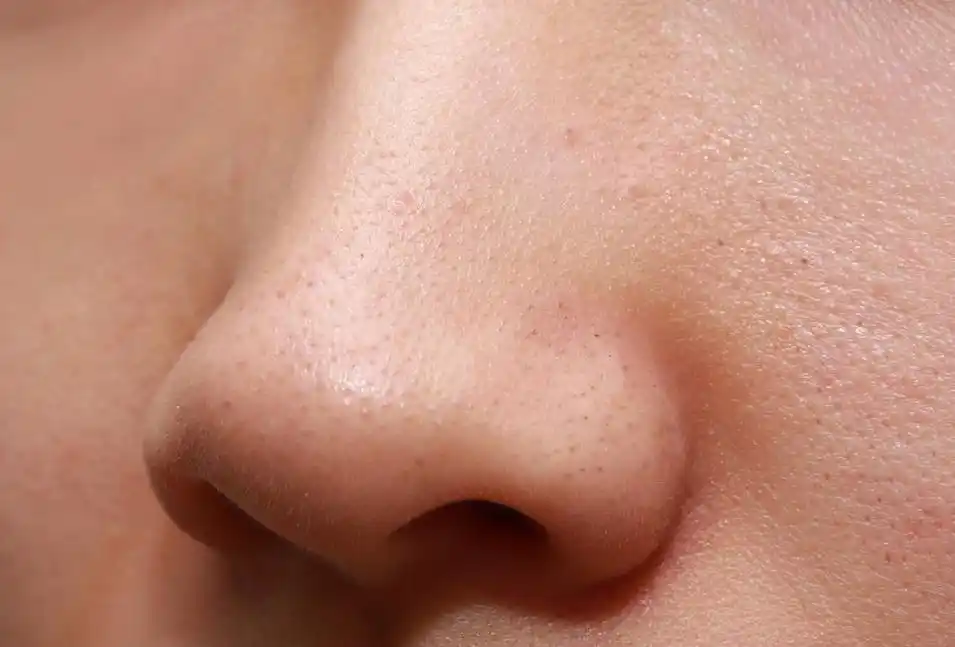 鼻子毛孔粗大,还能挤出"黄色小虫"?别急,教你3招清除它