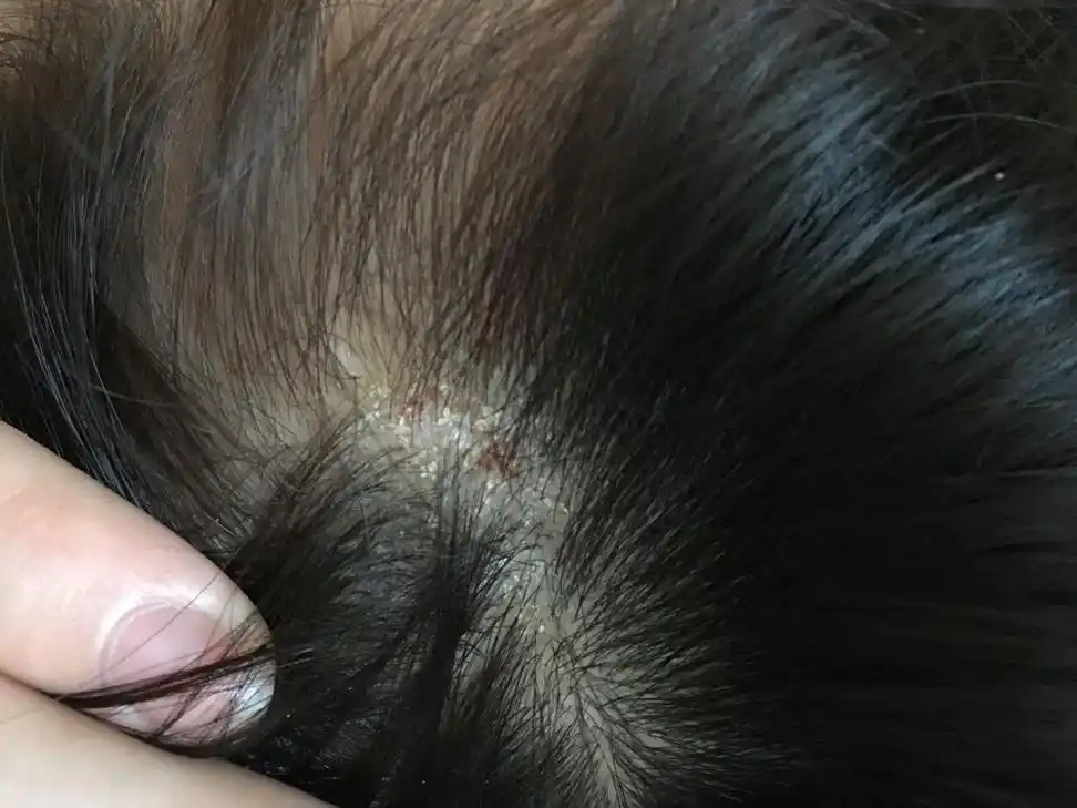 2016-04-25 08:20    浏览  33333  满意回答 你好,从图片看像是头癣