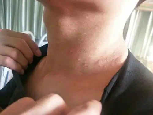 北方到重庆,从脖子上开始长了小疹子,很痒,是什么,改如何治疗?