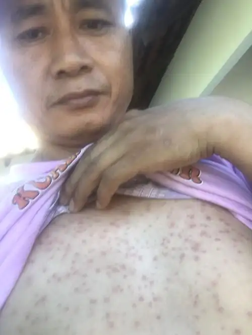 各网友胸前长豆豆毛襄炎用什么药膏