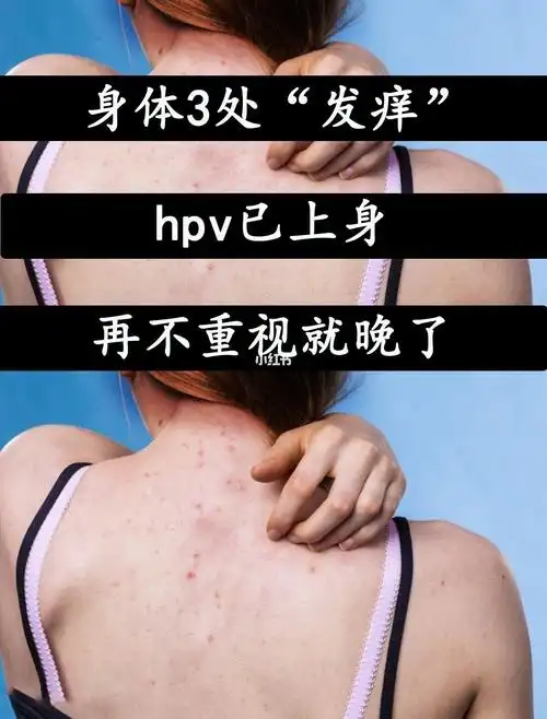 身体366处痒hpv已上身再不重视就晚了