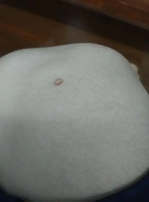 脚不知道怎么会长了一颗小肉 需不需要把它弄掉