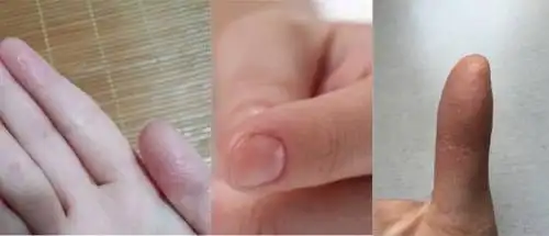 警惕长期吃手指可导致龅牙这些情况下孩子吮指立即喊停附方法