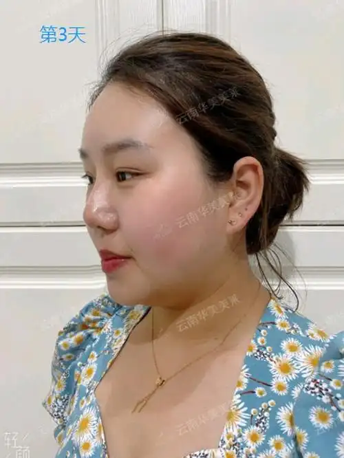 现在是刚打完玻尿酸填充泪沟的第三天,基本没有什么不适的症状了,没有