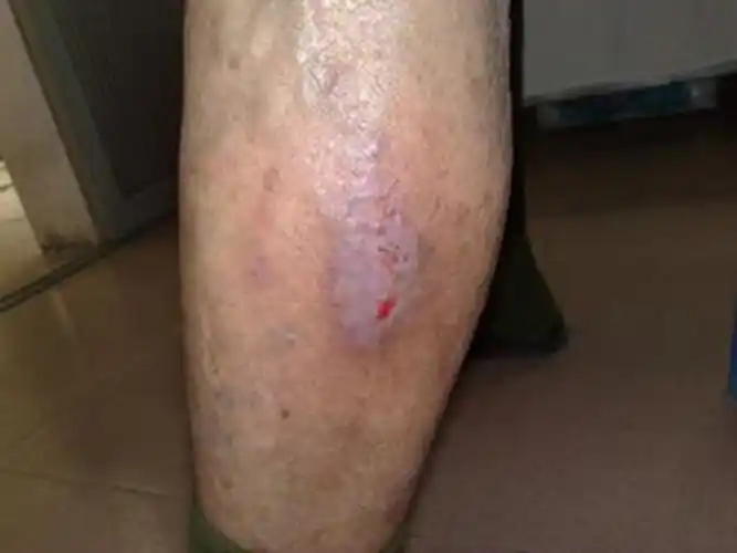 孕妇疥疮初期腹部皮肤症状图片