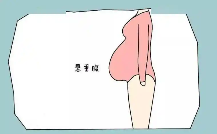 p>悬垂腹是,一种怀孕的腹型,腹部向前膨胀隆起,胎儿不宜入盆,即使