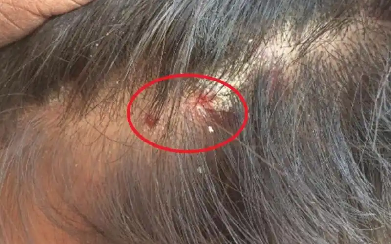 头皮里长出的这种小疙瘩到底是什么东西今天终于知道了