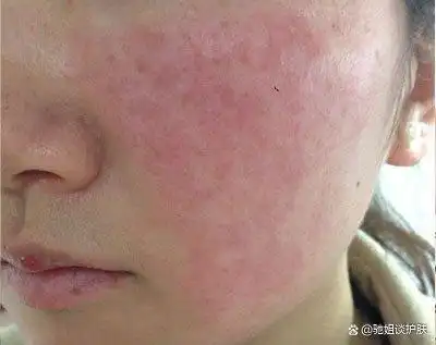 正在过敏的肌肤建议停用所有护肤品,用冰水或生理盐水湿敷镇静肌肤