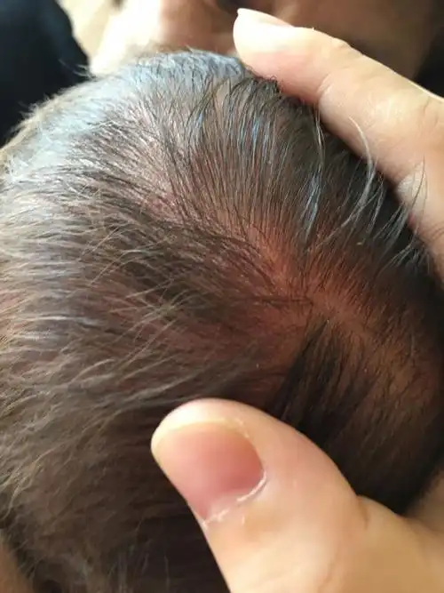 宝宝出生二十天,头皮上有大块红色,还有黄色的结痂,请问是怎么回事?