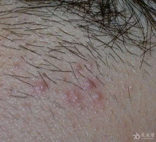 颈部皮疹看图诊断 - 皮肤及性传播疾病讨论版 - 爱爱医医学论坛