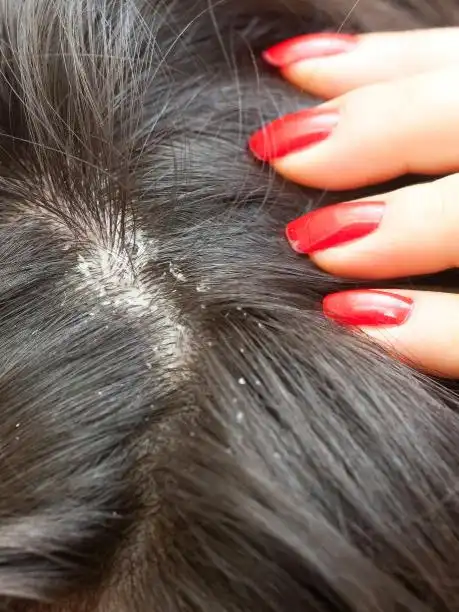 干性头皮屑_小红书