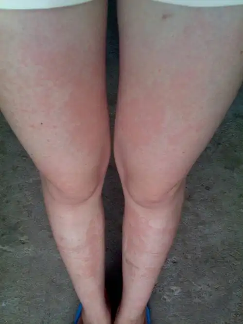 麻疹 从今年二月份到现在已近发病快5个月了 据老人小单方 皮肤医院