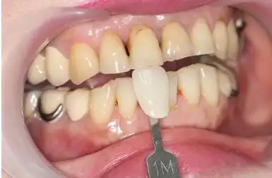 为什么大多数人尖牙会偏黄?-剧情奥秘