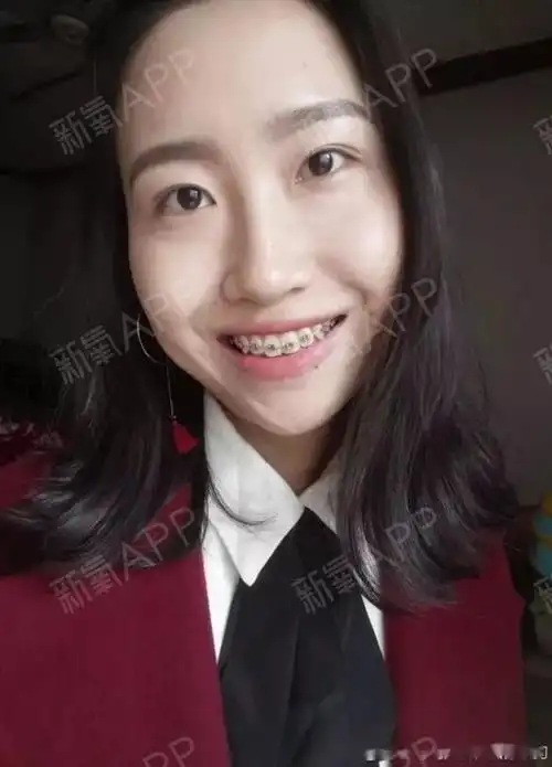 带牙套已经整整三个月啦,不对比不知道,翻出以前的照片,变化真的好大