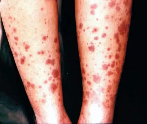 系统性红斑狼疮