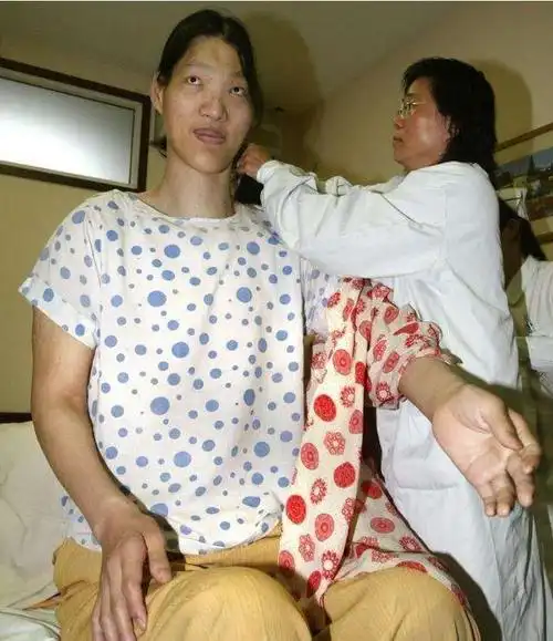 中国第一女巨人姚德芬身高236米曾梦想吃饱饭如今怎么样了