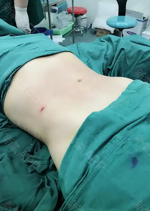 来分享一下我的吸脂经历啦,我做的是腰腹环吸,选择这_圈子-新氧美容