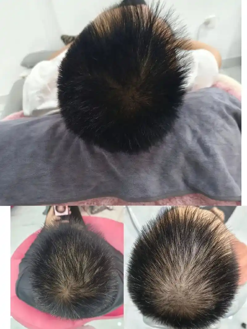 黑奥秘育发效果图对比.#防脱生发 #增加发量 #脂溢性脱发 - 抖音