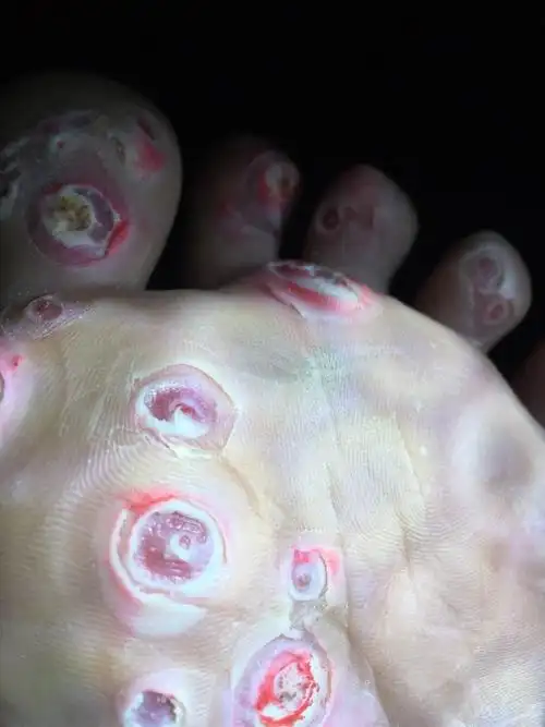 鸡眼膏贴成这样了,还需要继续贴下去吗?