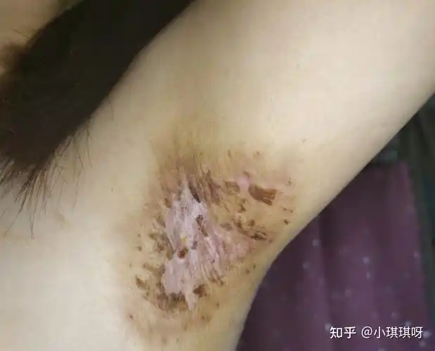 关于腋臭 - 知乎