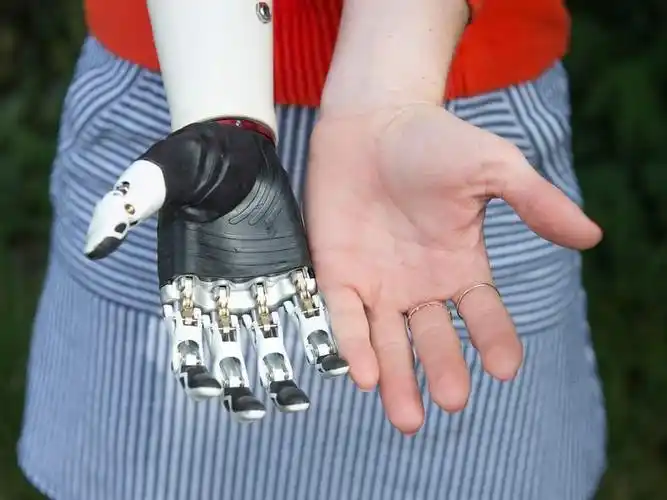 手从手腕截肢了可以带假肢吗?6假手手指能动靠谱吗?