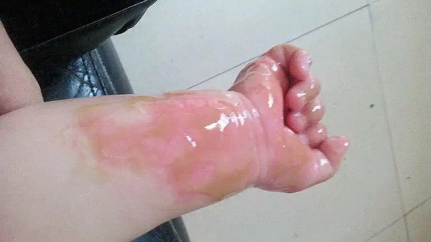 孩子被开水烫伤怎么办(被开水烫伤有哪些处理方式)_克勒塔百科