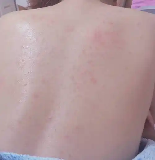 原创背上长痘痘怎么消除是不是螨虫