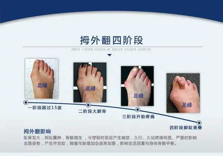 日夜使用拇外翻矫正器 功能:拇外翻,大脚骨,拇囊炎,重叠脚趾矫正使用