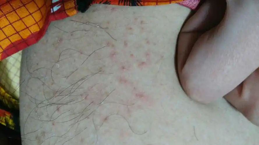 洗澡第二天发现大腿内测根部起一片小红点不痛不痒