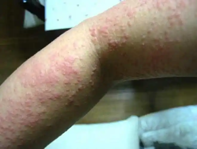 公开!湿疹图片初期症状图"随遇而安"-第1张图片-酷虎博客